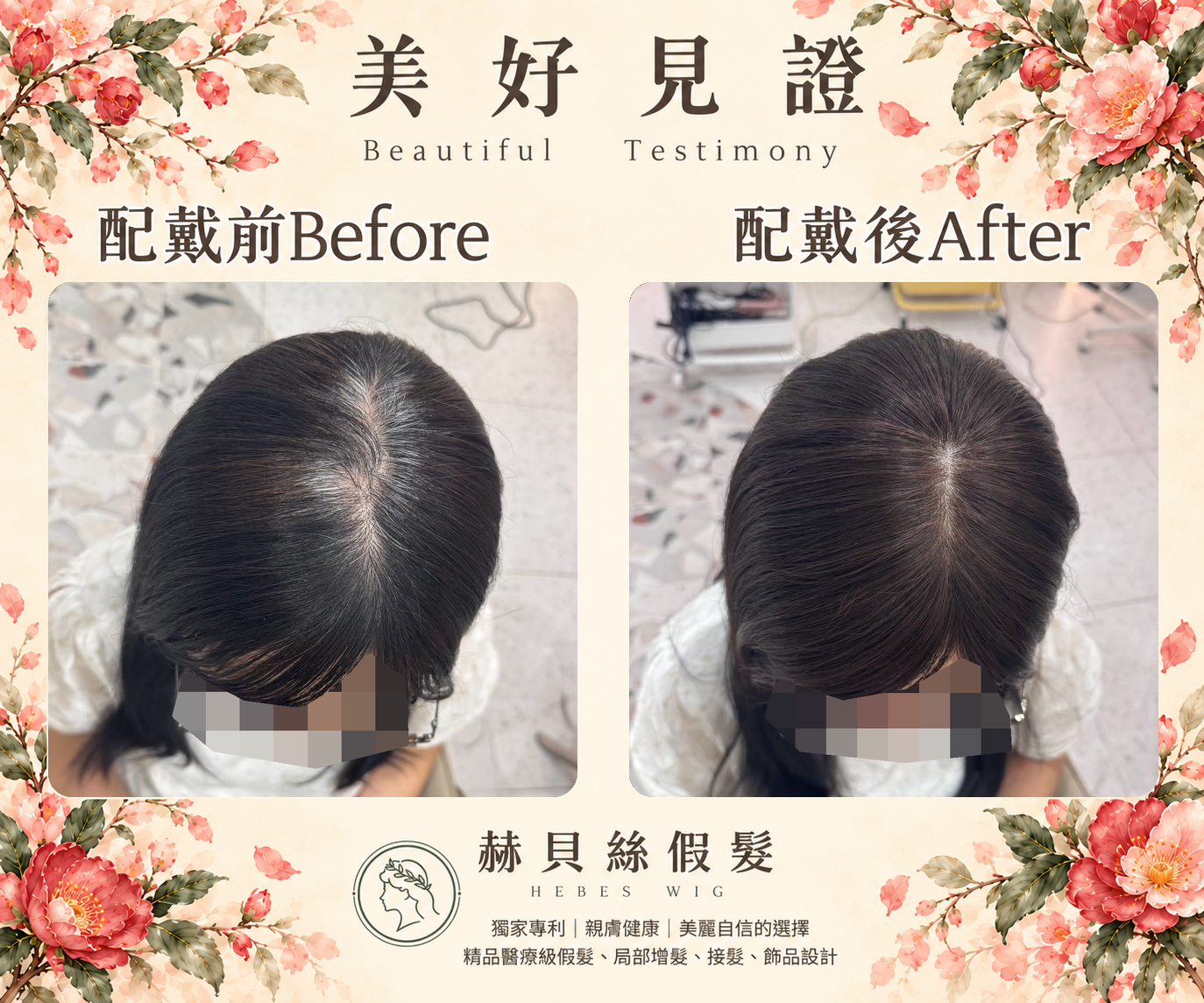 黃女士的美好見證:先生的用心,陪她找回自然年輕的模樣|配戴前後對比照