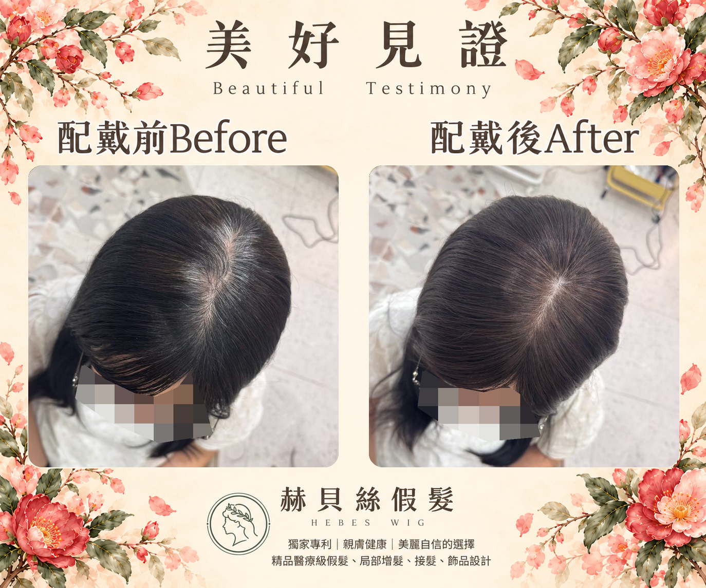 黃女士的美好見證:先生的用心,陪她找回自然年輕的模樣|配戴前後對比照