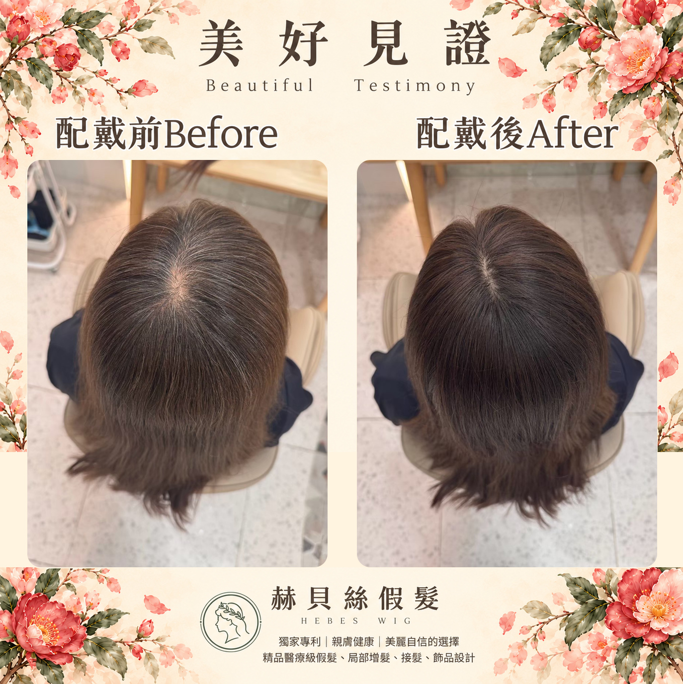 文小姐的美好見證:把心力留給生活,把美麗與自信還給自己|配戴前後對比照