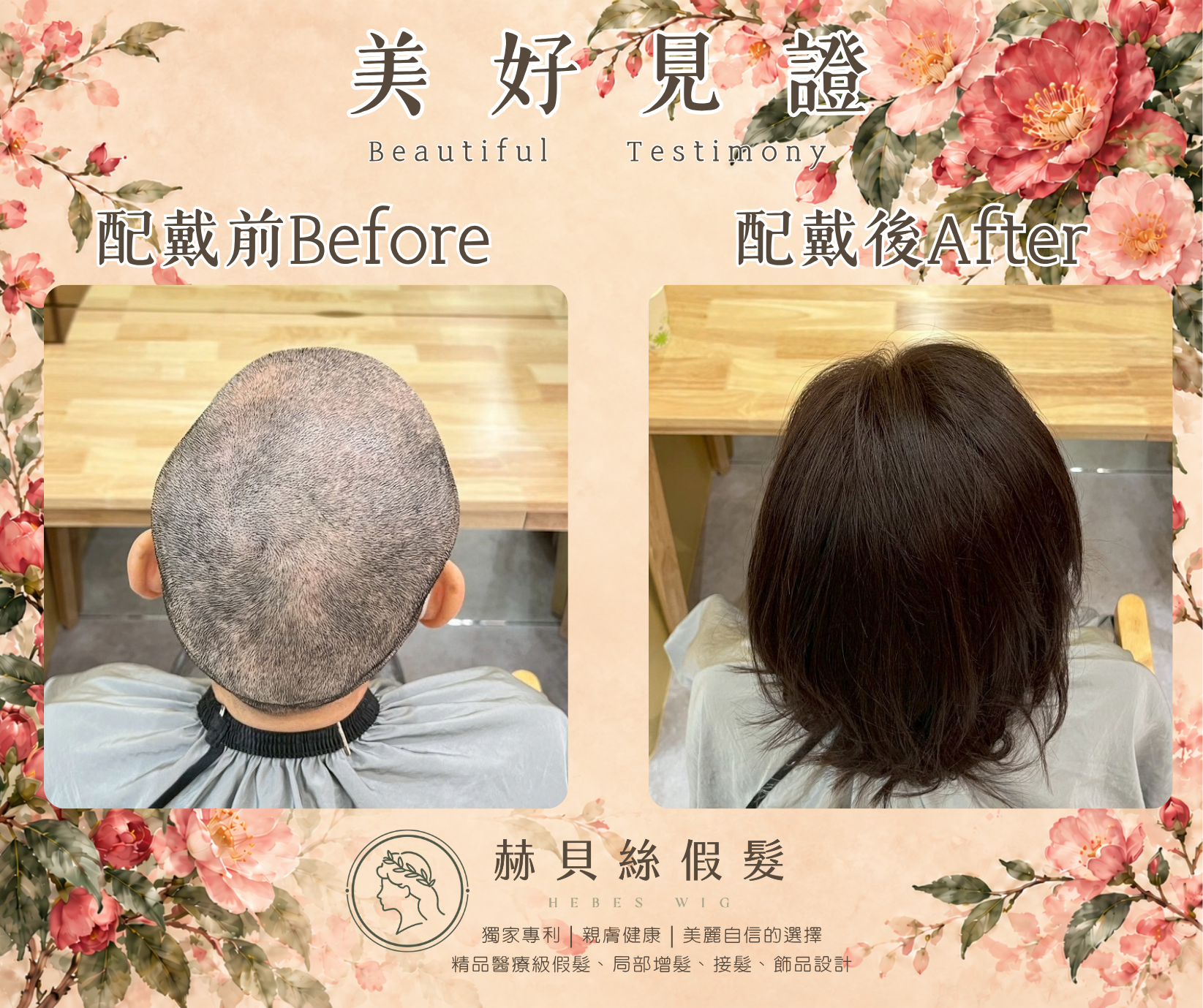 孫女士的美好見證:癌友互助社群的一份推薦,共同的自信與喜悅|配戴前後對比照